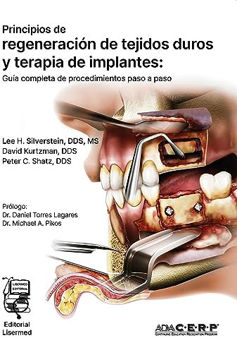 Principios de regeneración de tejidos duros y terapia de implantes:: Guía completa de procedimientos paso a paso