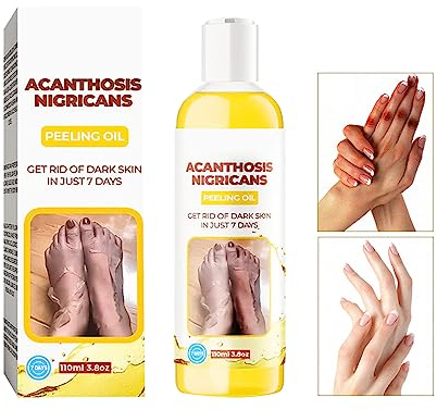 Fengyang® Aceite Peeling Corporal, Aceite Peeling Exfoliante Corporal, Peeling Corporal para Manchas Oscuras Corporales, Blanquear Y Suavizar La EliminacióN De Callos, Tez Iluminadora