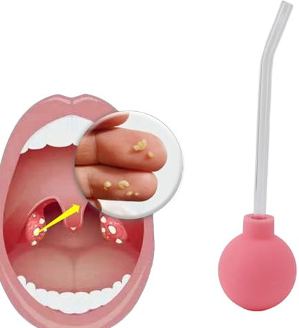 Dissolvant de Pierre D'amygdale, Aspirateur de Dissolvant de Pierre D'amygdale pour le Traitement de la Mauvaise Haleine, Outil D'aspiration de Pierre D'amygdale, Traitement de