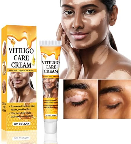 Grgowe Vitiligine,Crema macchia bianca,Crema Vitiligine Per Macchie Bianche,Crema Vitiligine,Vitiligine-Cura Della Pelle Vitiligine,Crema Repigmentante Per Macchie Della Pelle Bianca E Vitiligine