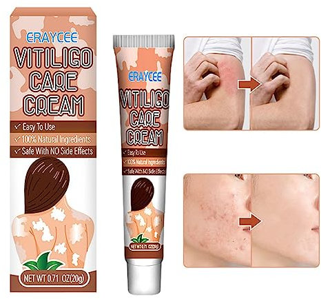 Crema per la cura della vitiligine – 20 g di crema vitiligine rigenerante, sollievo e rimozione | Crema facile da applicare contro le macchie bianche sulla pelle. Migliora i melanociti epidermici,