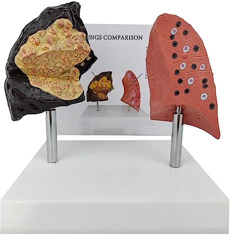 Smokers Lung Model + Healthy Lung Model,with Pathological Features And Accurate Anatomy Structure For The Effects Of Smoking On Lung Health