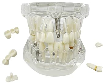 Genomskinliga sjukdomständer, YOUYA DENTAL genomskinliga tandimplantat tänder modell tandläkare standard sjukdom avtagbar tand patologisk undervisningsmodell