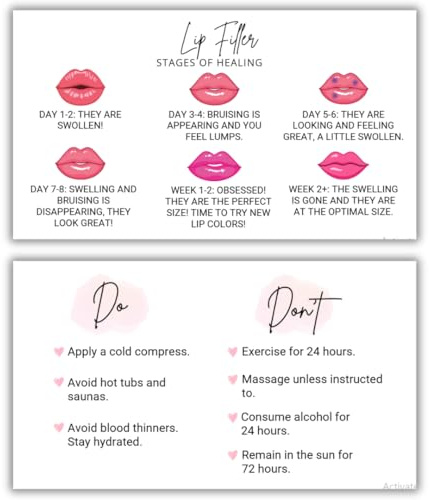 Lip Filler Aftercare Instructions Cards | 50 Pack | 2x3.5 Inch | Business Card Size | Hyaluronic Pen for Spa Esthetician | LEES A.M.