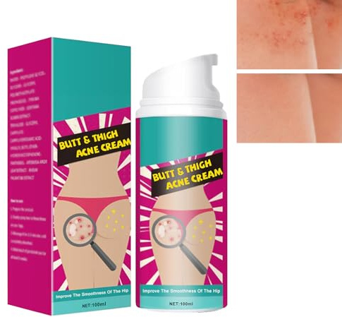 KOAHDE Crema de Acné de Cadera,Crema para Granos de Glúteos,Eliminar Granos de Gluteos,Eliminar el Acné en los Glúteos,Butt Acne,100ML,1pc