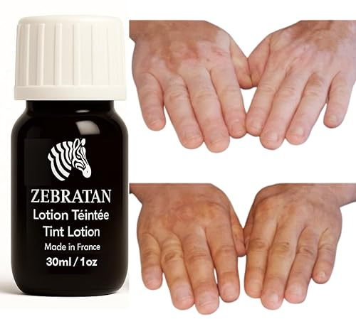 Trucco vitiligine su misura Zebratan - 30 ml beige chiaro - Lozione autoabbronzante - non grassa, non un fondotinta - mimetico piastre