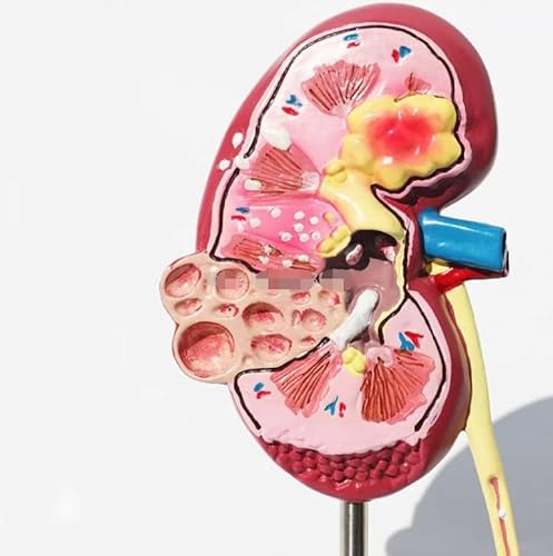 LUFAA 1pc Lesione renale Modello di reni Anatomia Umana Forniture didattiche Modello anatomico renale Medico Organo